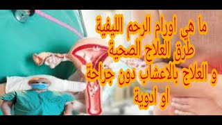 ما هي اورام الرحم الليفية و طرق العلاج الصحية و العلاج بالاعشاب دون جراحة او ادوية