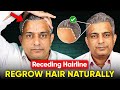 Receding Hairline Male Pattern Baldness Hair Fall Hair Thinning Lower Hairline And Hair Growth 