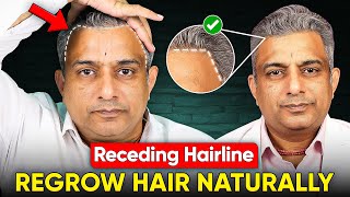 Receding Hairline - Male Pattern Baldness, Hair Fall, Hair Thinning, Lower Hairline, And Hair Growth