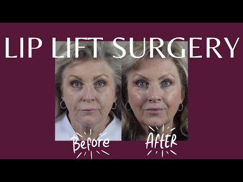 Video thumbnail: What is a Lip Lift Surgery? Before & After Lip Lift #bergencounty #plasticsurgery #lipflip — Paul Parker, M.D.