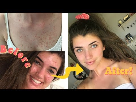 skincare routine/ how i cleared my acne/ chest acne