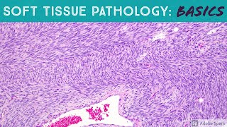 Basic Soft Tissue Pathology Cases: Explained by a Sarcoma Pathologist screenshot 4