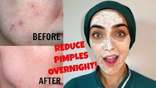 Disprin Tablet Facial To REMOVE PIMPLES FAST ~ Immy