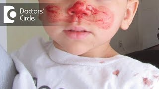 What are the common causes of nosebleeds in children? - Dr. Kumaresh Krishnamoorthy