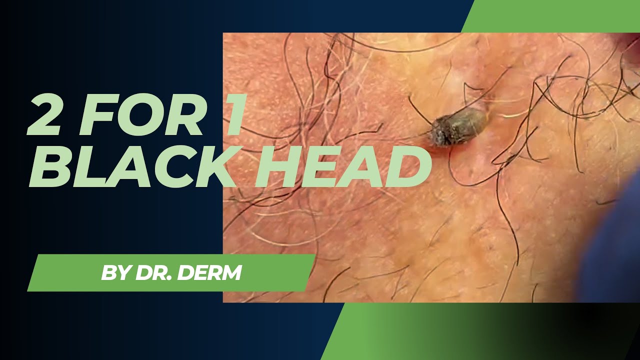 Blackhead – Dr Derm newest video