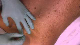 Celebrity MXT Eclipse Rover_ A New Dry Needling Technique for pain relief Profile
