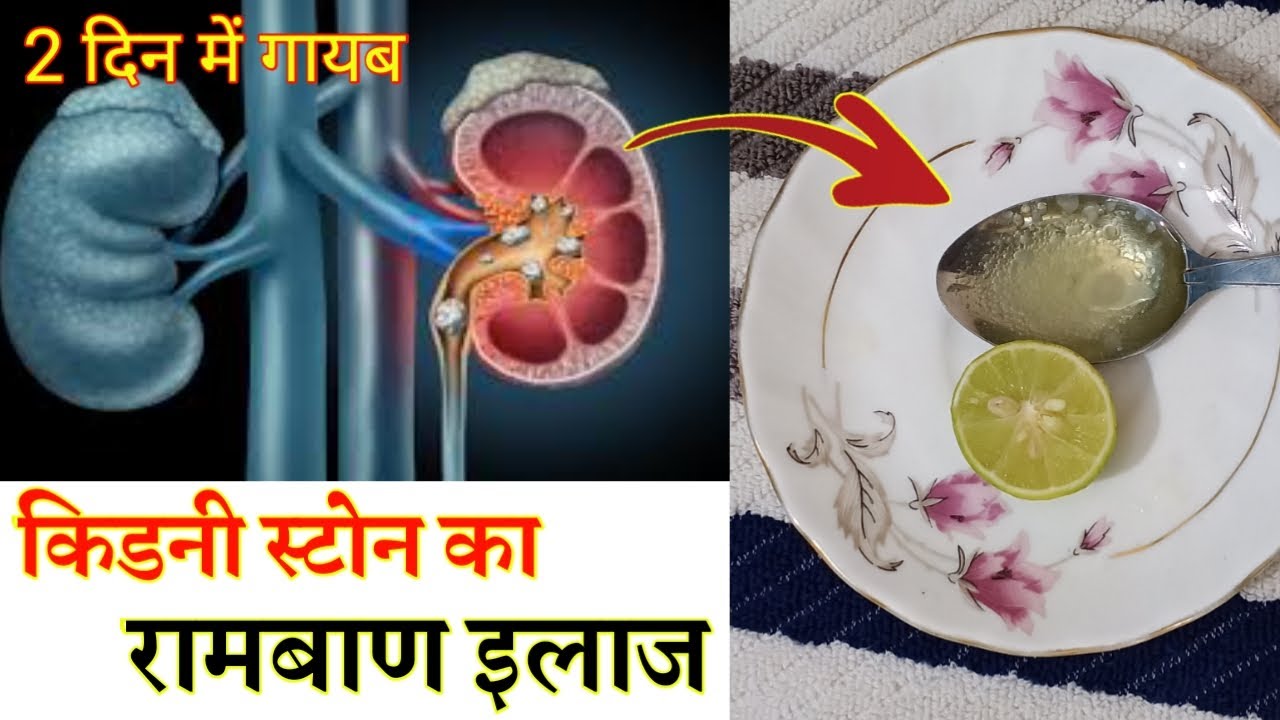 किडनी स्टोन का सबसे आसान घरेलु उपचार Kidney stone homemade treatment