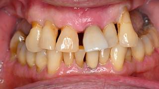 He Was Too Embarrassed to Smile... THIS Changed Everything | All-on-X Dental Implants
