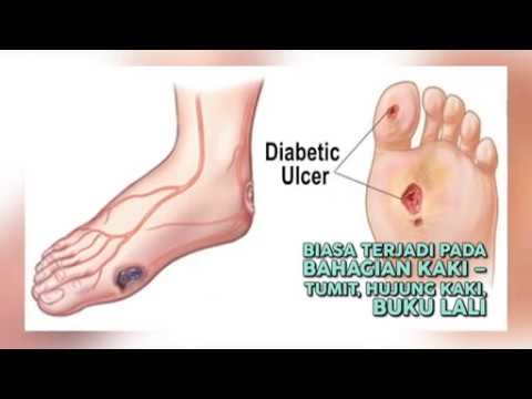 Video: Sakit Kaki Kencing Manis Dan Ulser: Punca Dan Rawatan