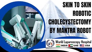 Innovation in Robotic Surgery: Emergence of Skin to Skin Robotic Cholecystectomy Using Mantra Robot