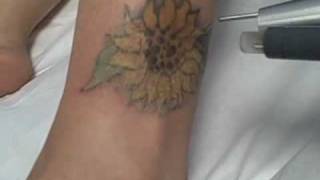 Los Angeles Tattoo Removal - Removal of Flower Tattoo on Ankle at Dr. TATTOFF Clinic