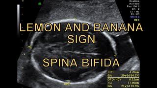 SPINA BIFIDA- LEMON & BANANA SIGN MADE EASY