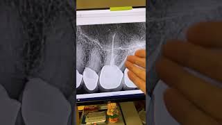I redid this 94-year old’s root canal when she was 83 years old!