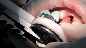 Benex Extraction System