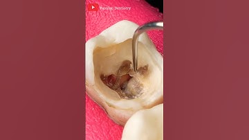 Cleaning Tooth Decay#teeth#shorts