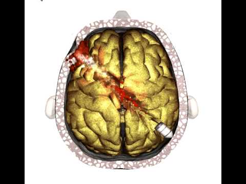 Brain Injury - Gunshot - YouTube