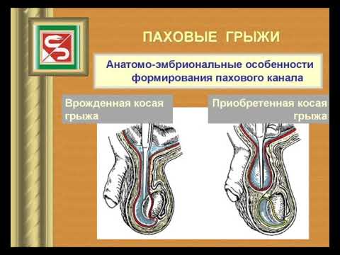 Оперативная хирургия 2. Грыжи  передней брюшной стенки (2 часть)