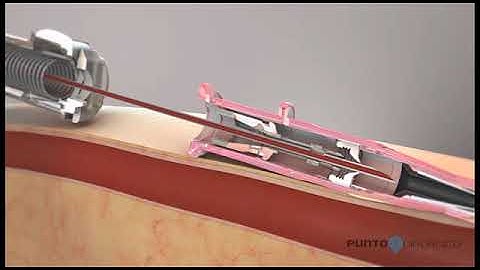 ¿Como funciona un catéter?