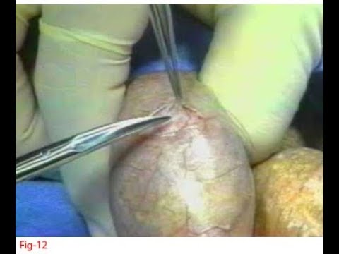 অণ্ডকোষ-থেকে-শুক্রাণু-সংগ্রহ--কখন-করবেন-(testicular-sperm-aspiration--when-to-do)