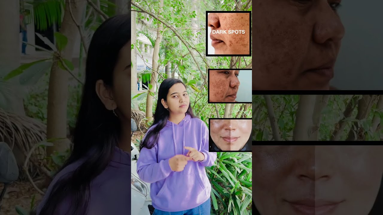 Kojic Acid Cream Review Pigmentation Acne Prone Skin Whitening Kojicacid Skincare Kojicsoap