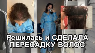 Андрогенная алопеция | СДЕЛАЛА ПЕРЕСАДКУ