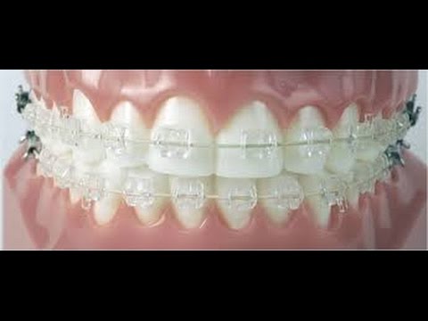 Zakładanie aparatu ortodontycznego ile trwa