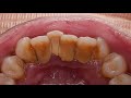 TEETH SCALING PROCESS | Dentist | Dokter Gigi Tri Putra