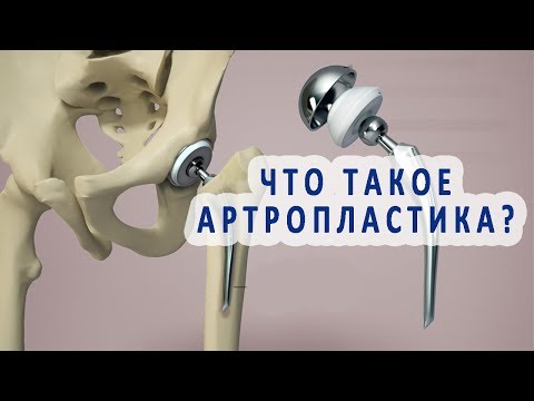 Что нужно знать об артропластике