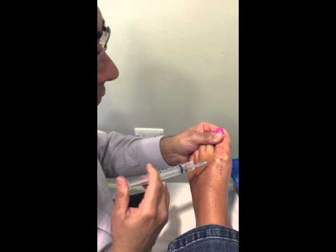 Big toe arthritis steroid injection