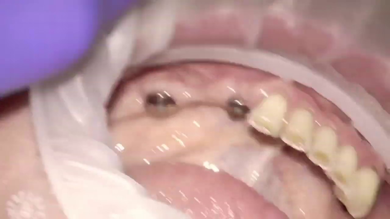 Straumann Bone and Tissue Level dental implant closed tray impression