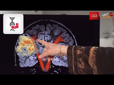 Vidéo: Dropsie Du Cerveau Chez Les Adultes, Les Enfants Et Les Nouveau-nés