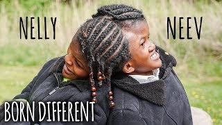 Conjoined Twin Sisters Attached At The Head | BORN DIFFERENT