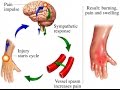 Complex Regional Pain Syndrome (CRPS)