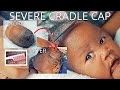 HOW TO GET RID OF ECZEMA + CRADLE CAP ON NEWBORN SCALP FAST!! | Bubs Bee