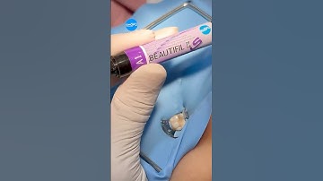 Composite restoration Stamp technique to restore lower molar 🦷 tooth #dentist #shofu