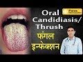ORAL THRUSH TREATMENT | MEDICINE FOR ORAL FUNGUS | WHITE COATED TONGUE