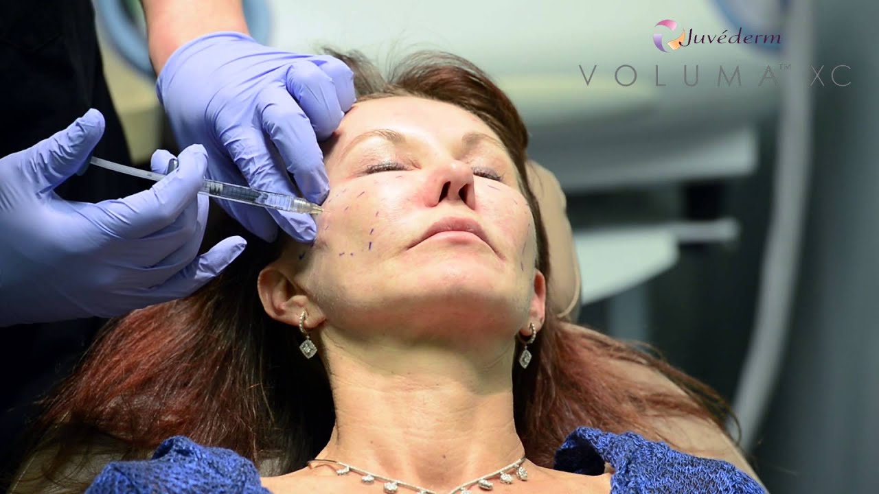 Voluma Injection performed by Dr. Jon Mendelsohn