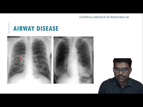 Video: RTG COPD: Obrázky, Diagnostika A Další