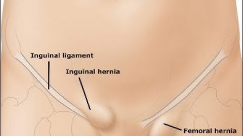 Repair Femoral Hernia CPT code - simplify medical coding