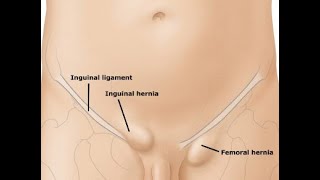 Repair Femoral Hernia CPT code - simplify medical coding