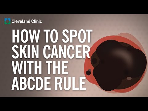Video: Da li melanom uvijek znači rak?