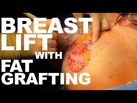 Breast Lift with Fat Grafting - Dr. Paul Ruff | West End Plastic Surgery