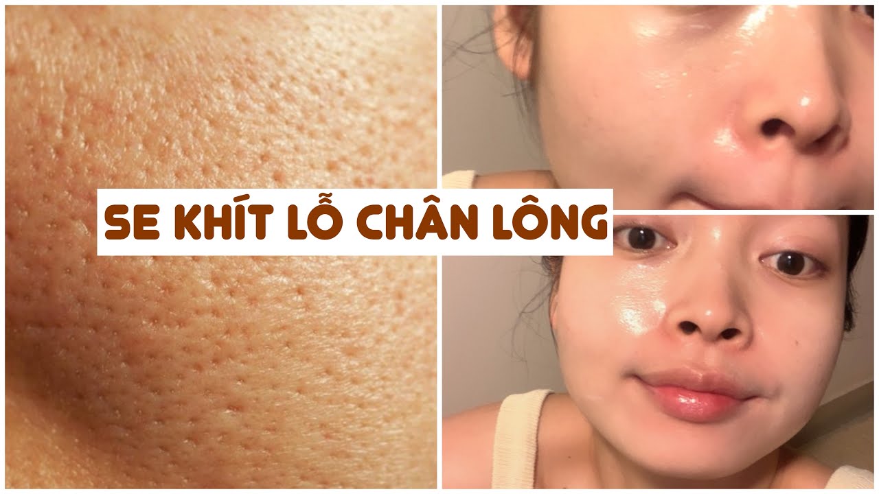 3 SẢN PHẨM THỰC SỰ SẼ GIÚP BẠN SE KHÍT LỖ CHÂN LÔNG NGAY LẬP TỨC