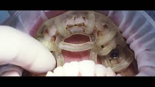 Guided Implant Placement With Mis V3 And Mguide