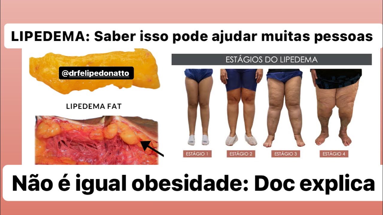 DIFERENÇA ENTRE LINFEDEMA X LIPEDEMA: O nutricionista deveria