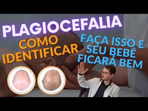 Vídeo: Por que a plagiocefalia é ruim?