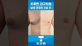 대구 지점의 남자 여유증 수술 후 1달 경과! 옷 맵시가 살아나는 라인의 변화.
