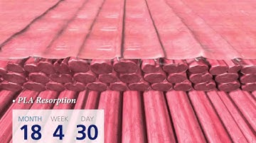 ProGrip™ Laparoscopic Self Fixating Mesh Overview