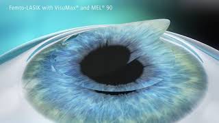 Femto LASIK with VisuMax and MEL90   bladeless lasik