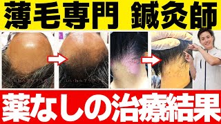 【ビフォーアフター】薬なしの薄毛治療でも、コレだけ変わります！